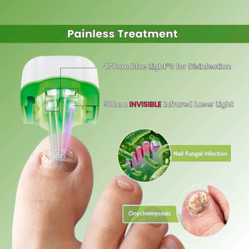 VivaVera™ - Nail Fungus Laser