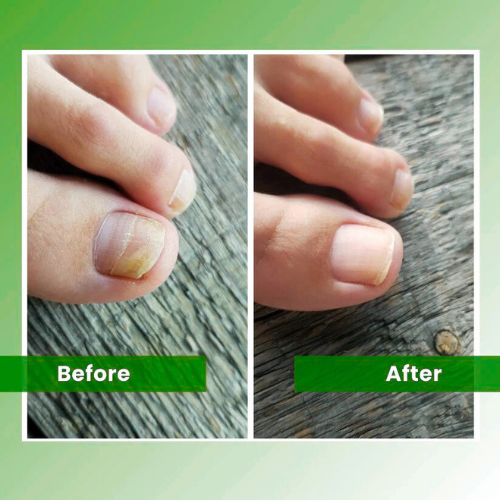 VivaVera™ - Nail Fungus Laser