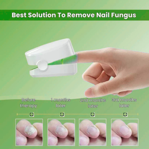 VivaVera™ - Nail Fungus Laser